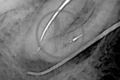 Reendodoncia1