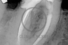 Reendodoncia2