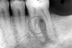 Endoperiodontal1