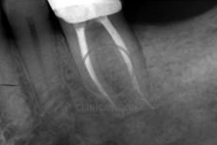 Endoperiodontal2