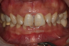 carillas_ceramica1