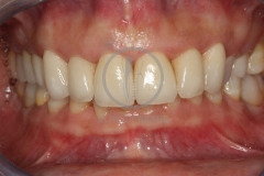 carillas_ceramica3