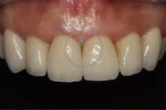 carillas_ceramica4