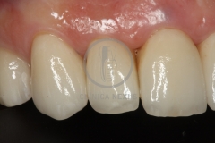 carillas_ceramica5