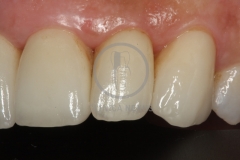 carillas_ceramica6