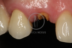 CoronaImplantoSoportada1