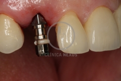 CoronaImplantoSoportada2
