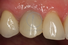 CoronaImplantoSoportada3