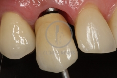 CoronaImplantoSoportada5