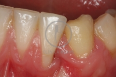 Cirugiaplasticaperiodontal1