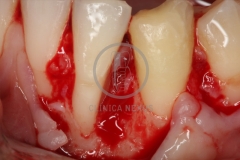 Cirugiaplasticaperiodontal3