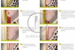 Cirugiaplasticaperiodontal5