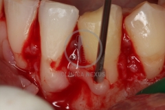 Cirugiaplasticaperiodontal6