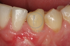Cirugiaplasticaperiodontal8