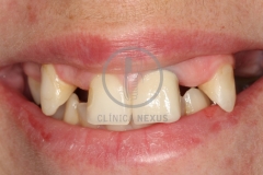 atrofiamandibular1