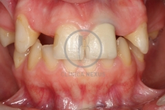 atrofiamandibular2