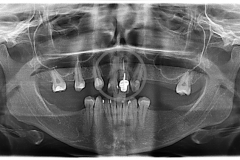 atrofiamandibular3