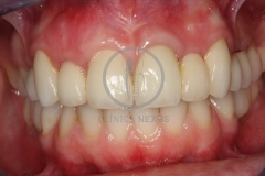 atrofiamandibular6
