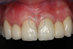 atrofiamandibular7