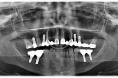 atrofiamandibular8