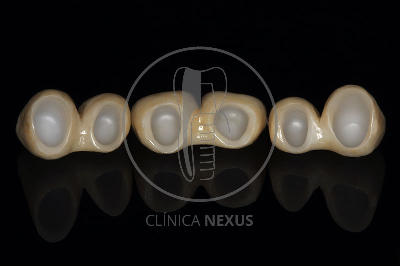 Rehabilitación sobre dientes e implantes en paciente periodontal