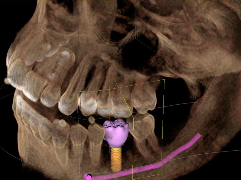 Tomografía Axial Computerizada (DentaScan). Clínica NEXUS