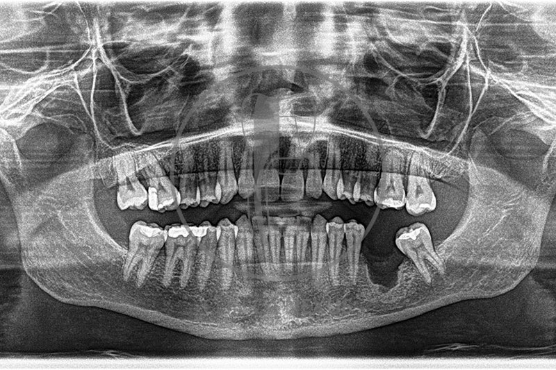 ROG vertical tras pérdida de un implante en sector posterior