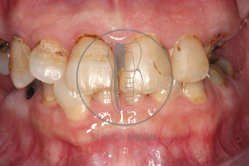 Rehabilitación sobre dientes e implantes