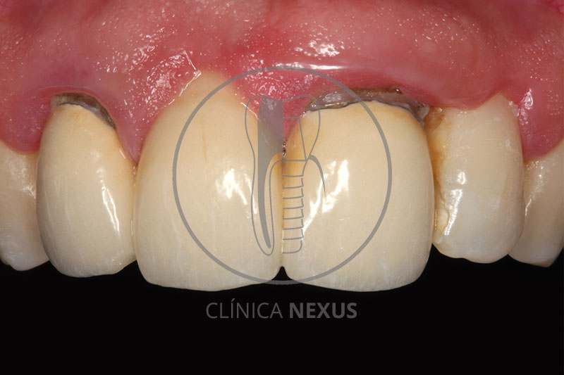 Retratamiento sector anterior con coronas sobre dientes e implante
