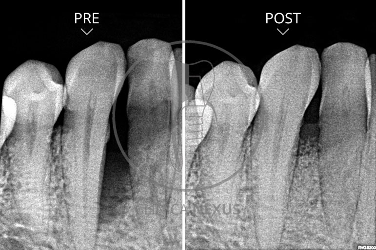 Regeneración Periodontal en defectos infraóseos extensos